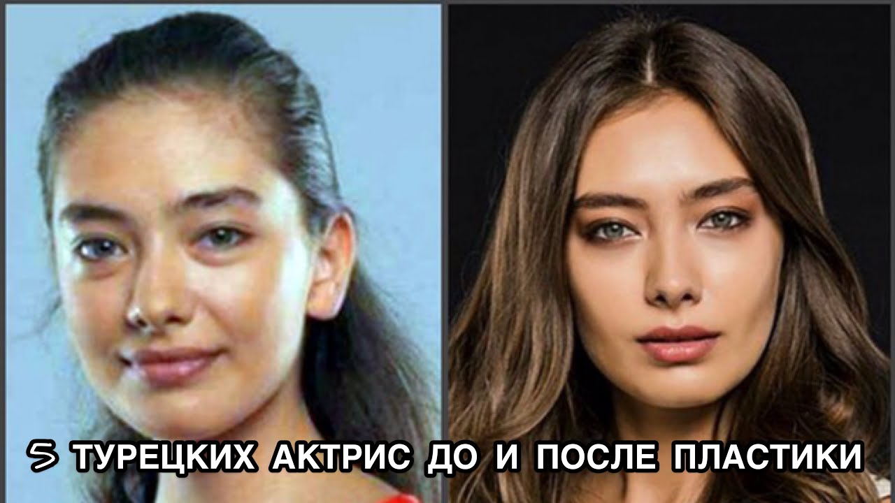 5 До и после пластики: 5 турецких актрис, которые изменили свою внешность ✨