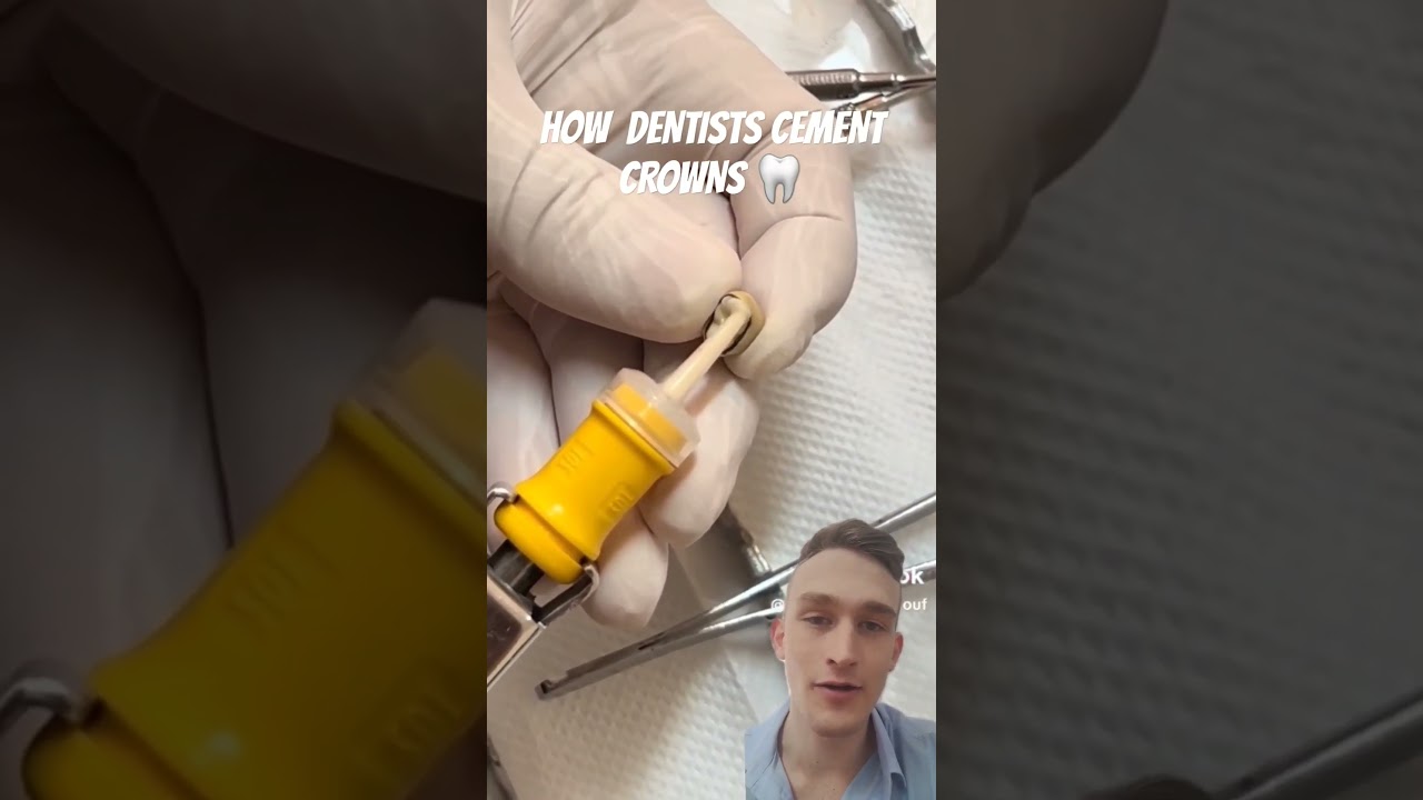 How Dentists Cement Crowns 🦷