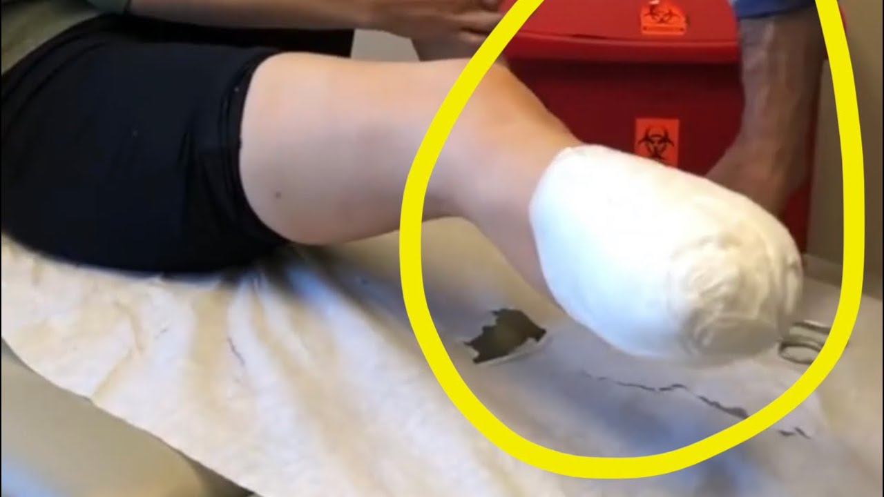 First Look at My Amputated Stump #Shorts