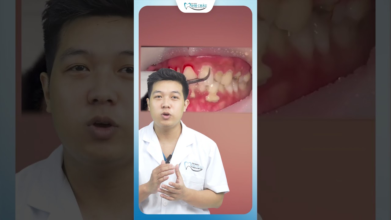 Điều Trị Cao Răng, Viêm Lợi & Phì Đại | Nha Khoa Minh Châu