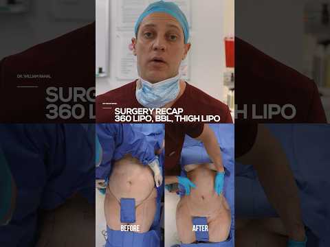 360 Lipo & BBL Results You Won’t Believe | Stunning Before & After!