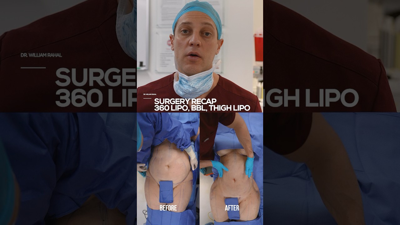 360 Incredible 360 Lipo & BBL Transformations | Stunning Before & After Results ✨