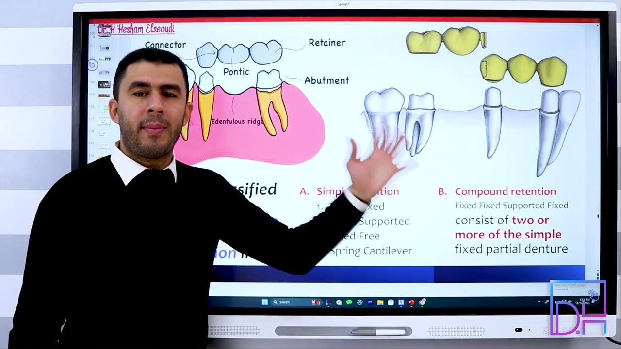 16- Dental Bridge (Fixed Partial Denture) Classifications P1
