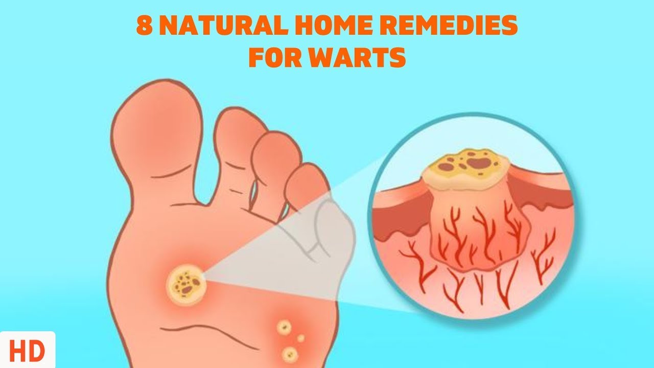 8 Natural Home Remedies to Remove Warts 🌿