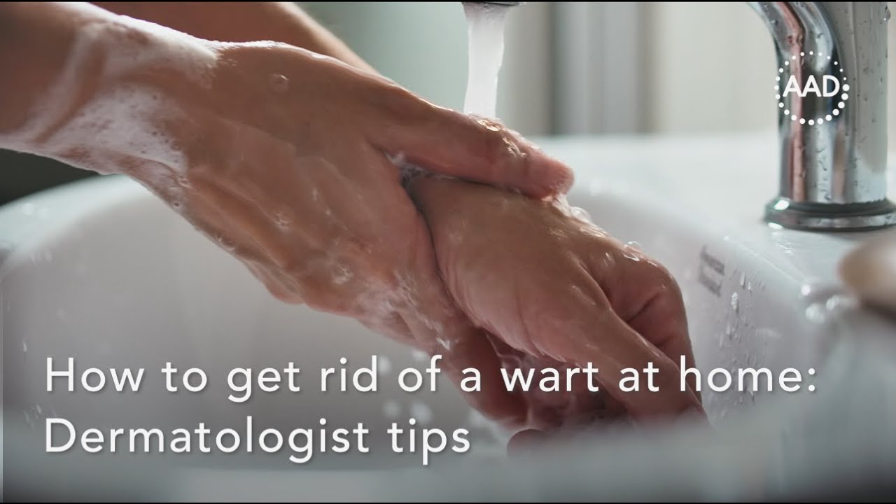 Home Tips to Remove Warts Safely 🩺