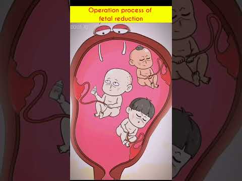 Operation process of fetal reduction #asmr #satisfying