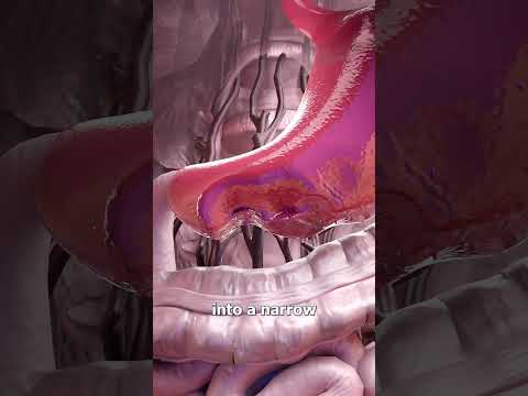 How Stomach Reduction Surgery Works 🤔