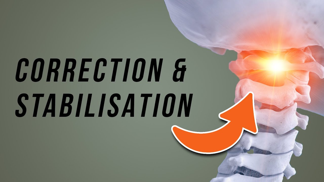 Atlas Misalignment and Upper Cervical Instability Exercises
