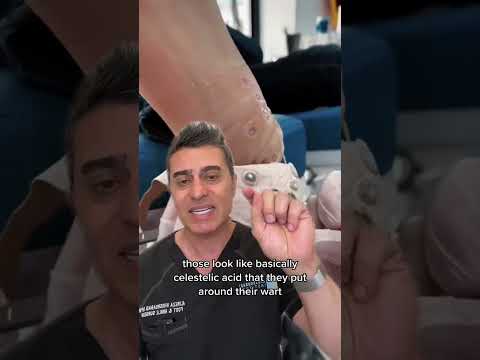 Shocking Plantar Wart Discovery!