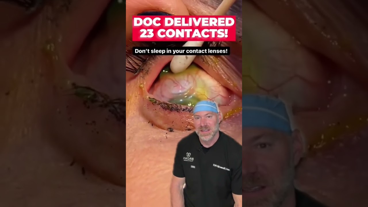 23 Contacts Stuck Behind Her Eye! 👁️