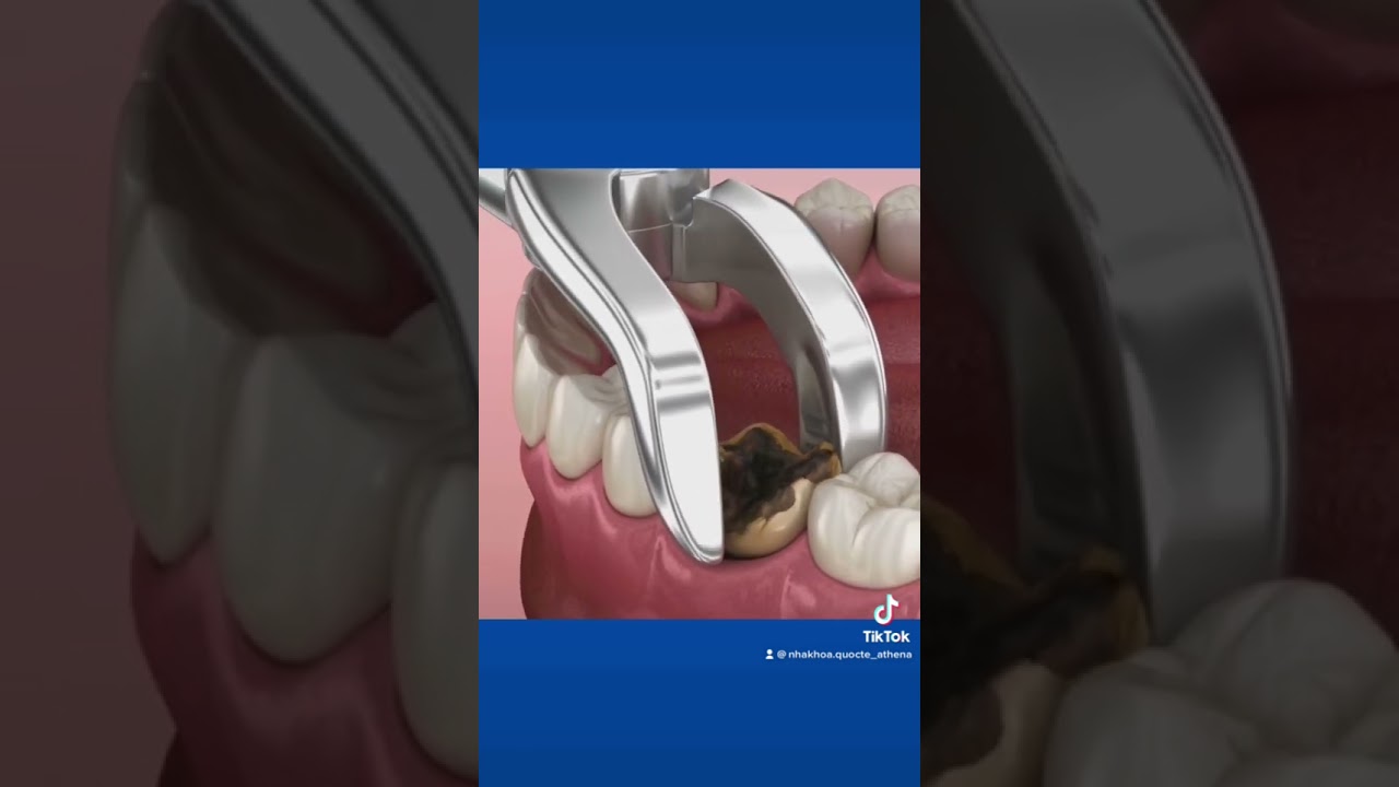 Quy trình Nhổ Răng Sâu Chi Tiết 🦷