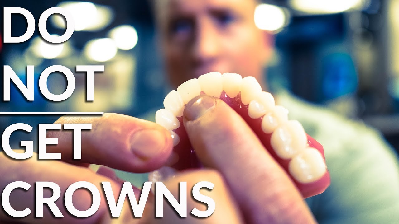 Avoid Crowning Front Teeth Before Dental Work 🦷