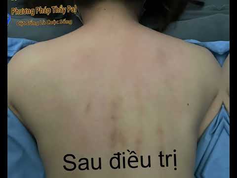 Điều Gì Xảy Ra Sau 1 BUỔI Được THẦY PAL Điều Trị GÙ VẸO CỘT SỐNG Tại Phòng Khám ❓❗️❓