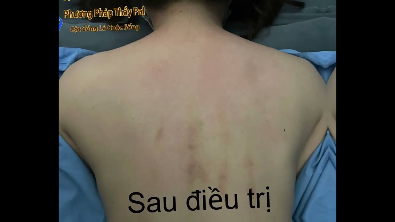 Chuyện Gì Xảy Ra Sau 1 Buổi Trị Gù Vẹo Cột Sống Bởi Thầy Pal? 😮