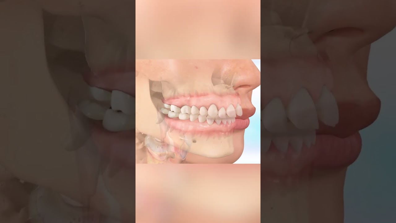 Giai đoạn khó khăn nhất khi niềng răng 😬