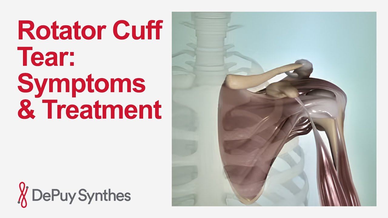 Torn Rotator Cuff: Causes, Symptoms & Treatment 🩺