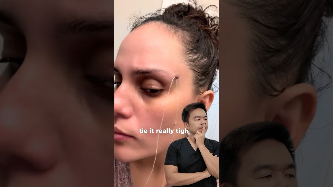 Can You Remove Moles with Dental Floss? 🤔