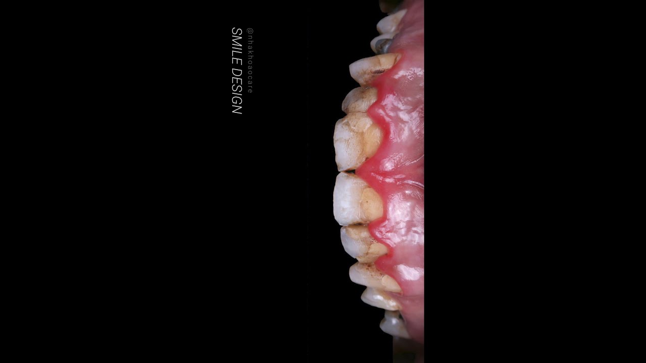 Thiết Kế Nụ Cười P.3 | Smile Design 😁