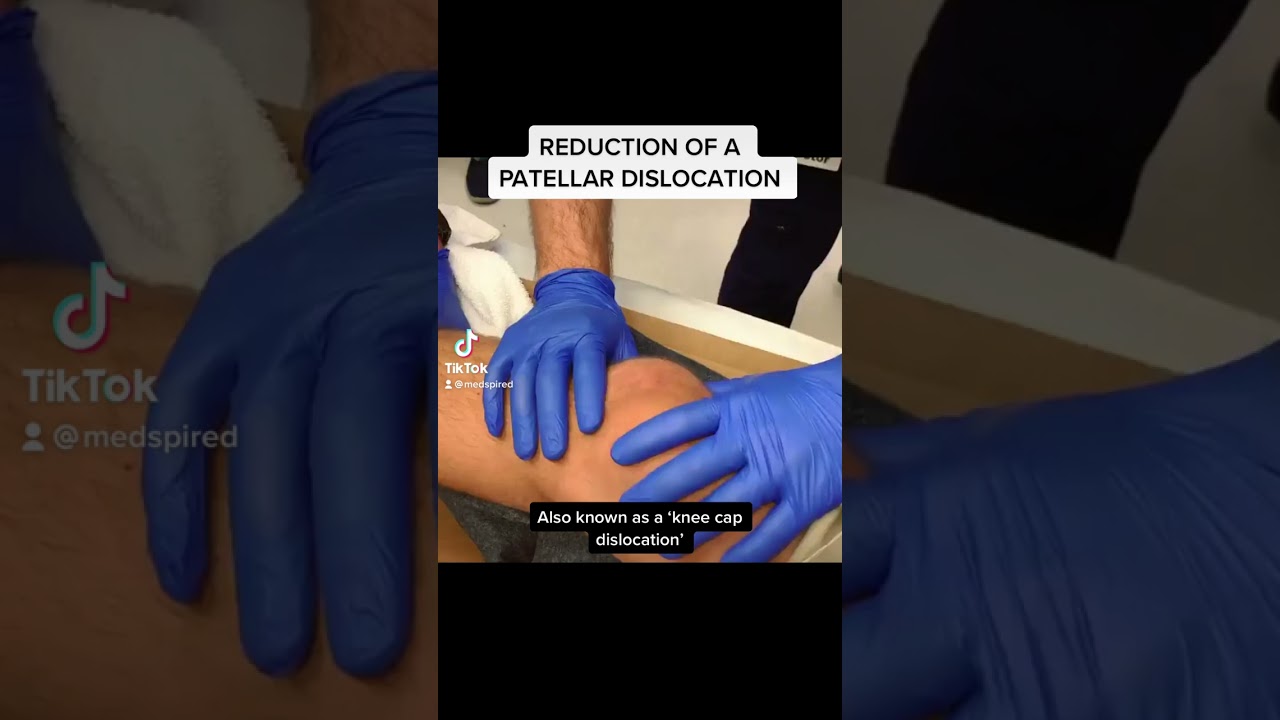 How to Treat and Prevent Patellar Dislocation 🦵