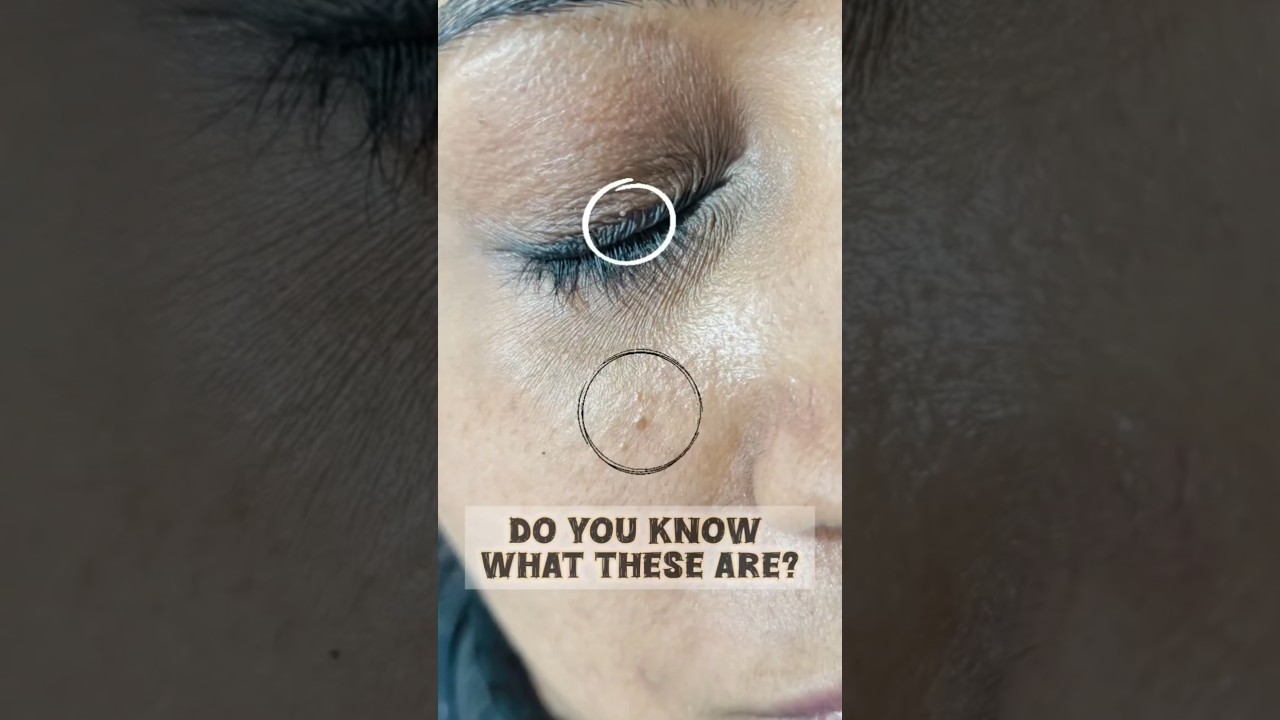 Effective Ways to Remove Facial Warts 🧴