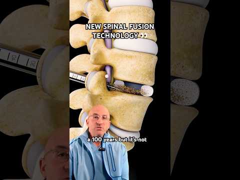 High-Tech Spinal Fusion for Back Pain Relief⁉️ #shorts