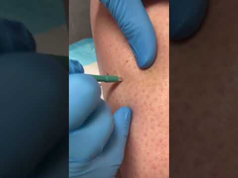 Derm Conducts Skin Cancer Testing 🩺