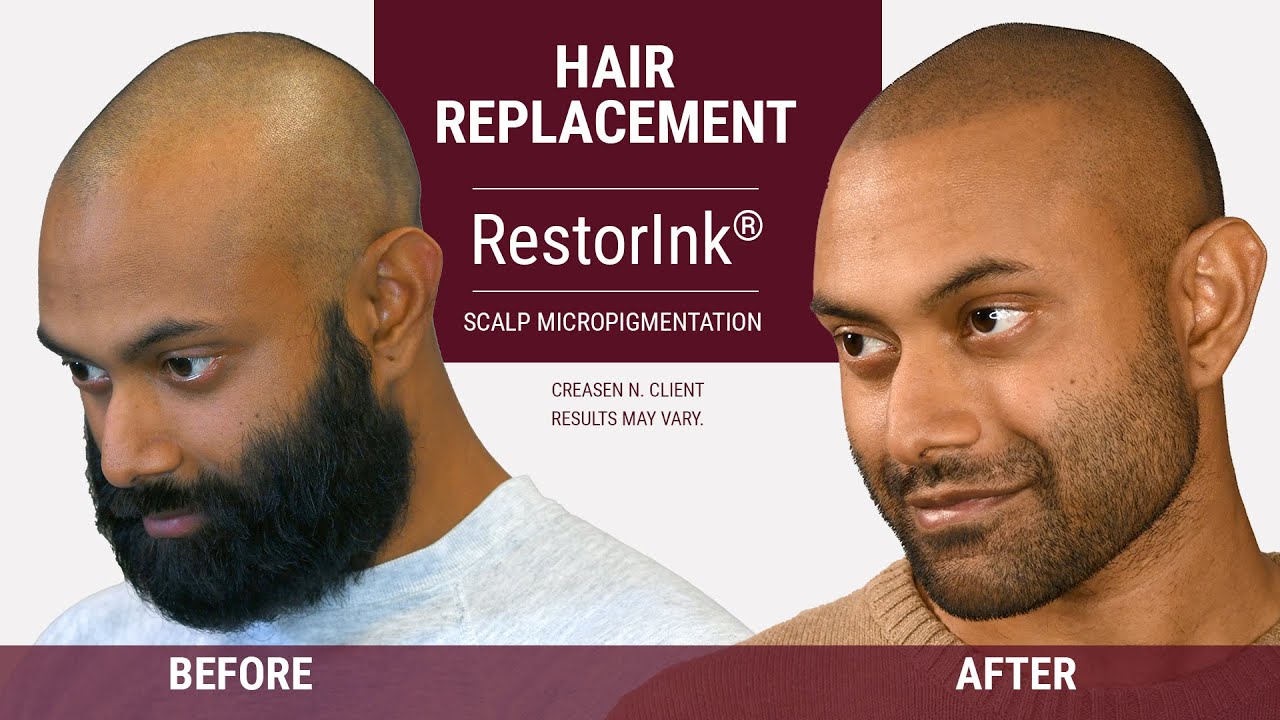 Restore Hairline with Scalp Micropigmentation | RestorInk®