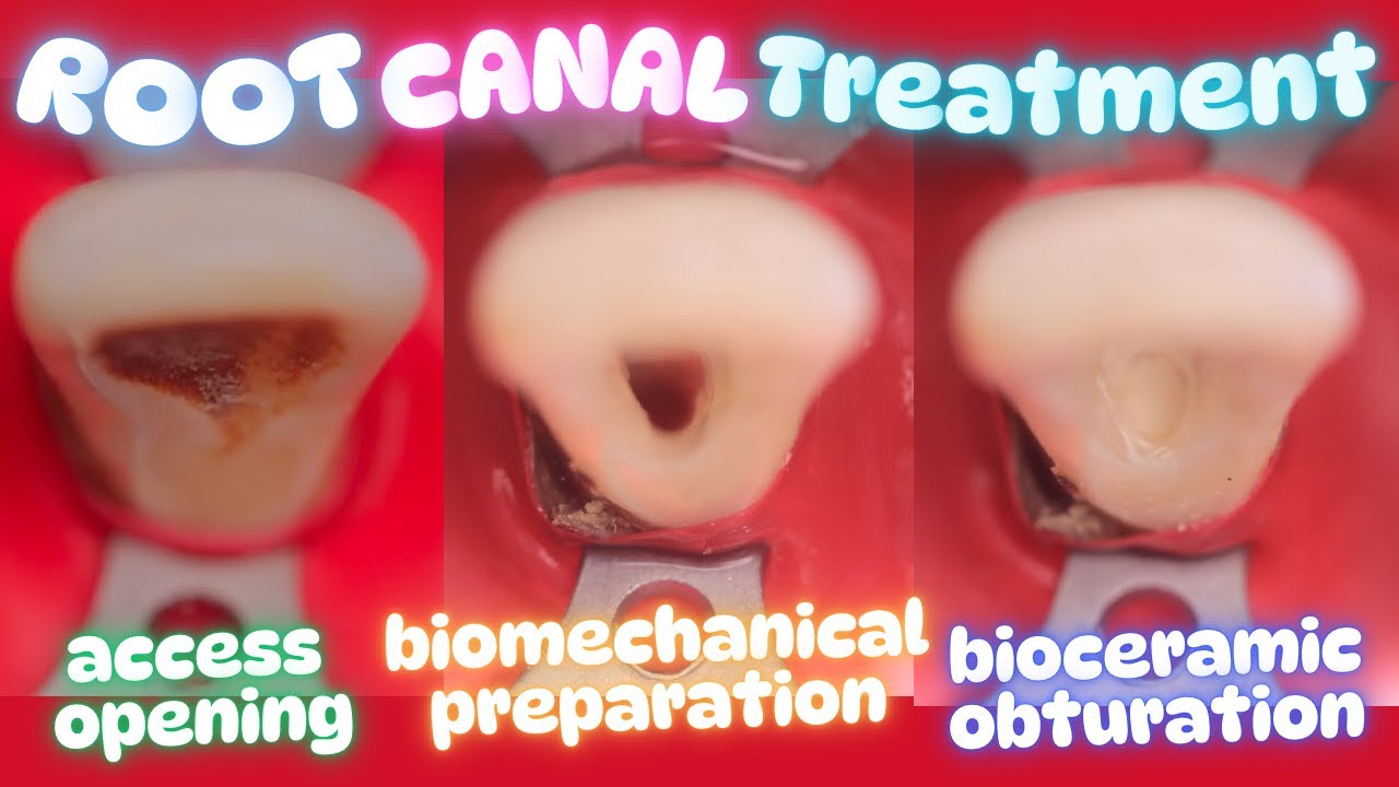 Root Canal in Maxillary Central Incisor π‘ Protaper Gold βͺοΈ