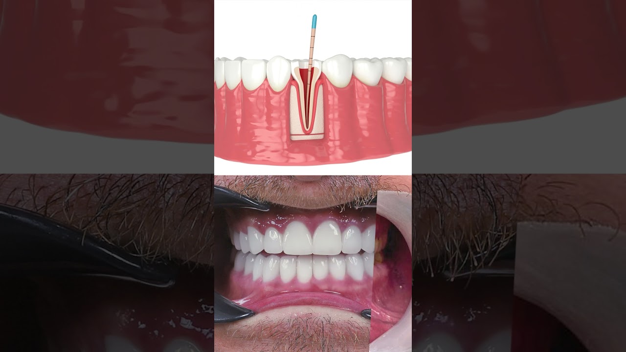 Root Canal Treatment in Turkey 🇹🇷 | Step-by-Step Process & Results