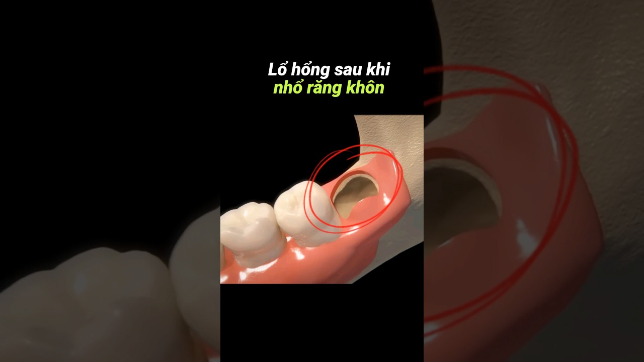 Cách xử lý lỗ sau nhổ răng khôn 🦷
