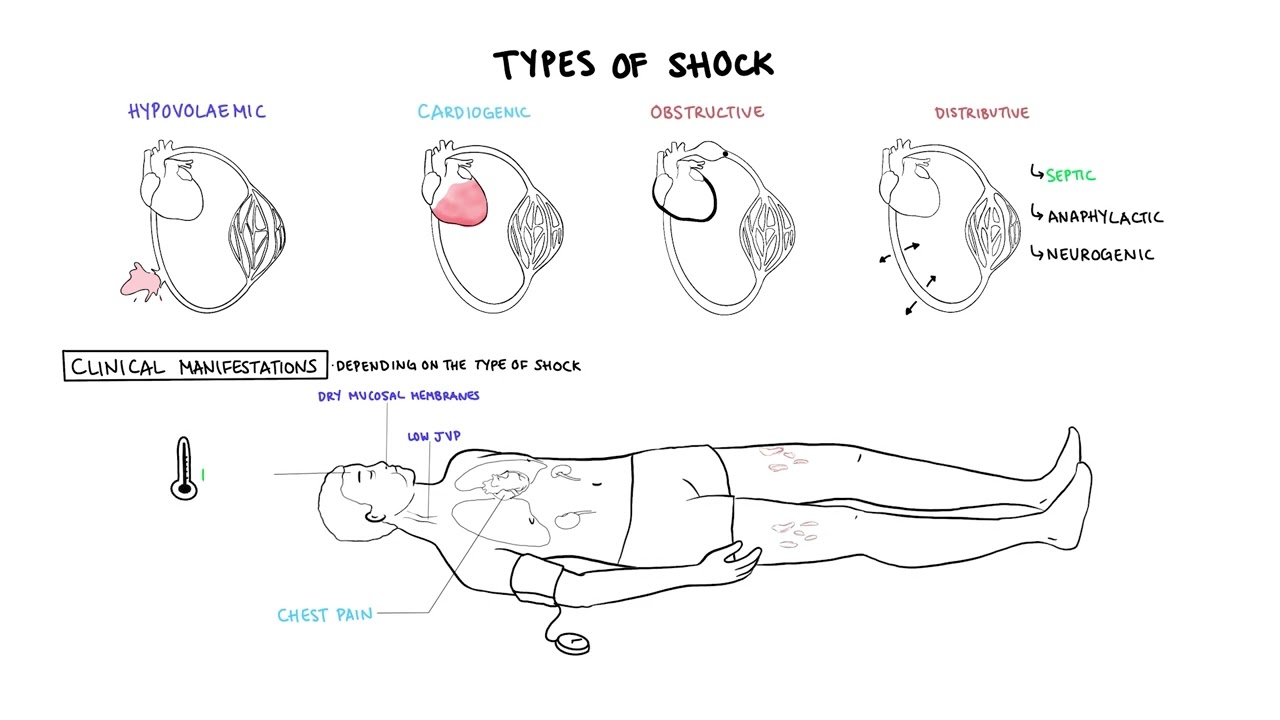 Shock Types & Management: Hypovolemic, Cardiogenic, Distributive, Anaphylaxis