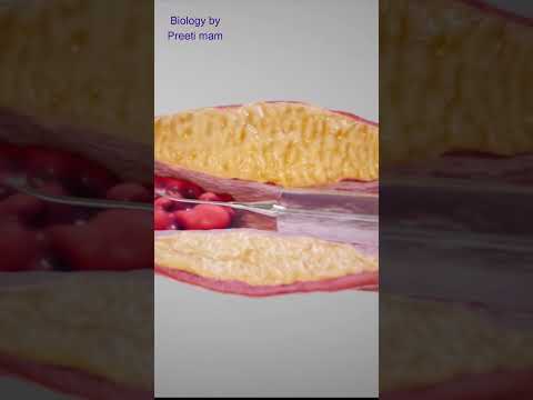 Angiography & Angioplasty kya hai or kaise hoti hai | एंजियोग्राफी क्या होती है और कैसे करते हैं
