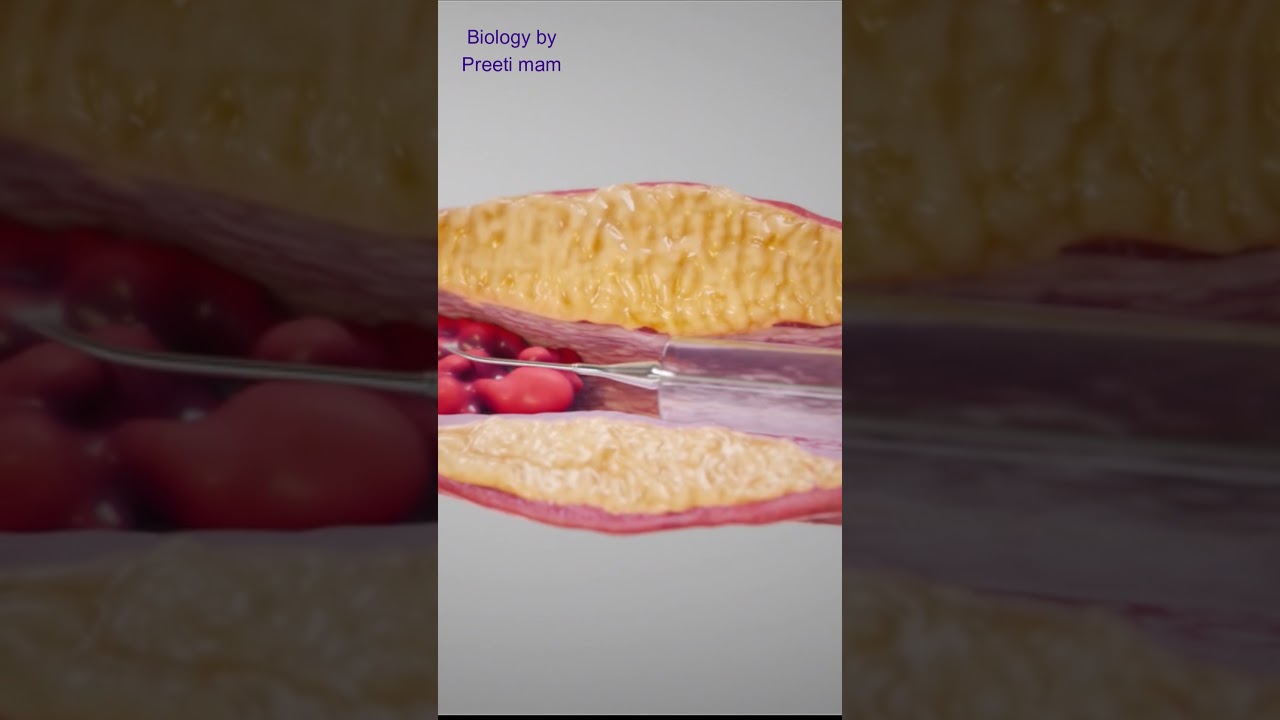 एंजियोग्राफी और एंजियोप्लास्टी क्या हैं? जानिए कैसे होते हैं ये आसान प्रक्रिया 🩺