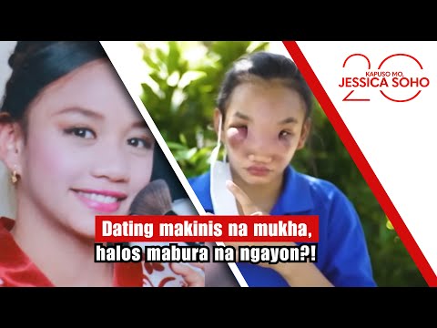 Dating makinis na mukha, halos mabura na ngayon?! | Kapuso Mo, Jessica Soho