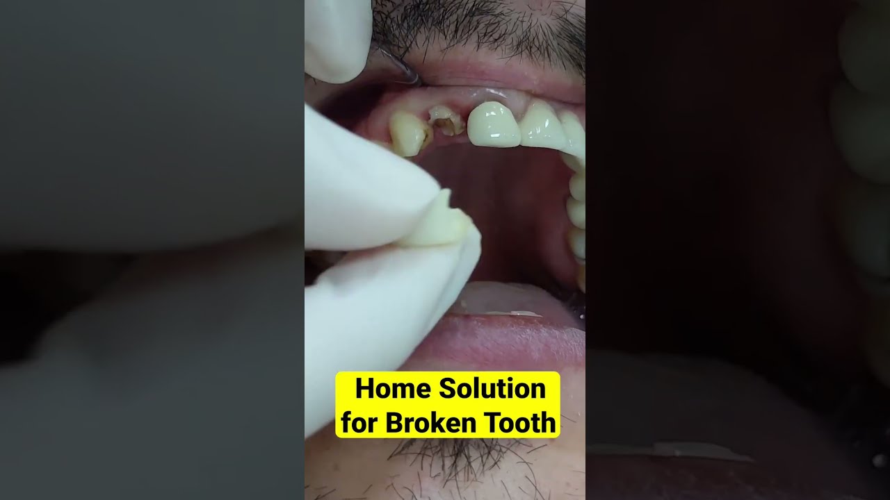 Fast Home Fix for Broken Tooth 🦷