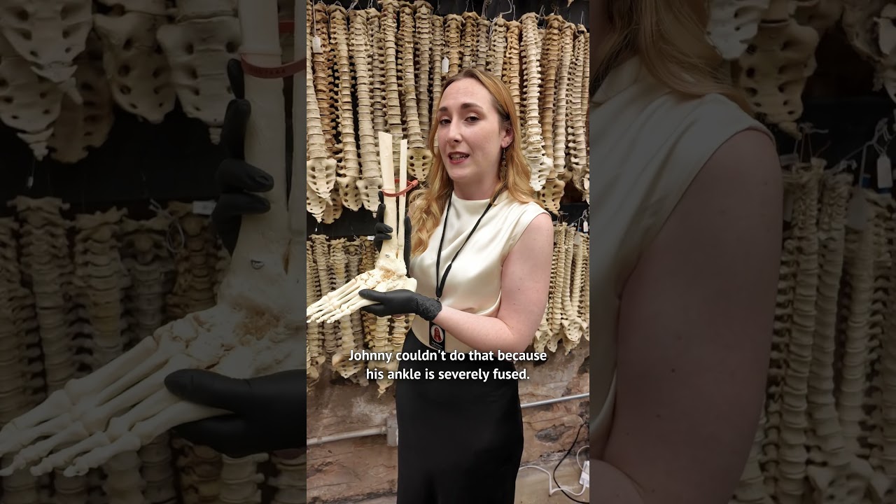 Johnny’s Leg: A Tale of Perseverance 💪