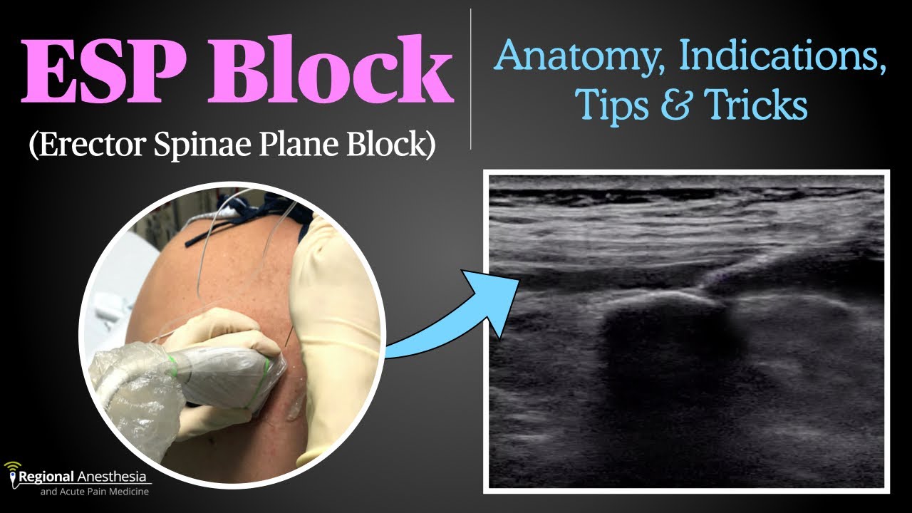 Erector Spinae Plane (ESP) Block Updated Video π₯