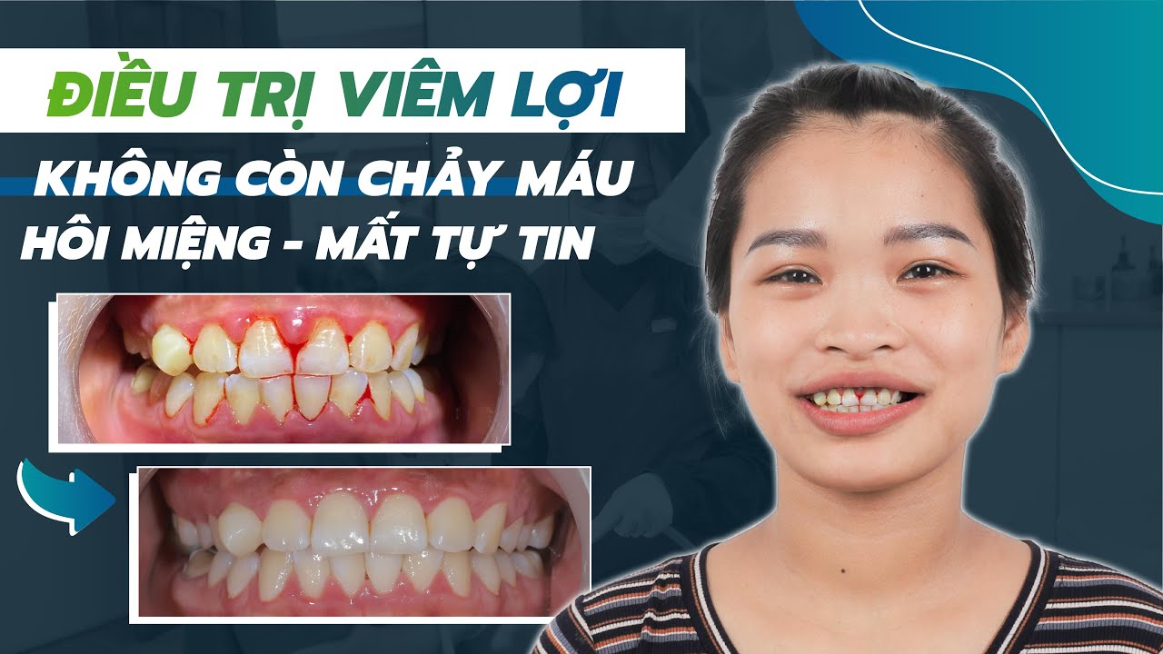 Điều Trị Viêm Lợi Hiệu Quả Như Thế Nào?