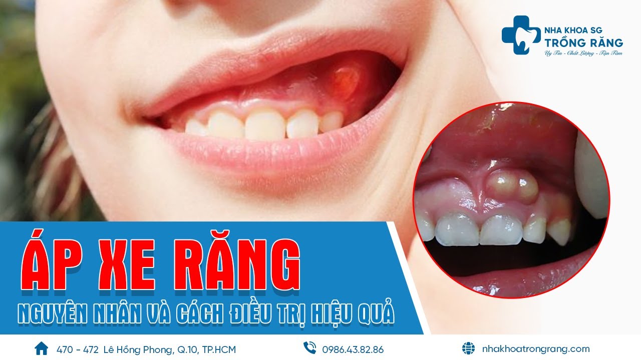 Áp Xe Răng Có Nguy Hiểm? Cách Điều Trị Hiệu Quả 🦷