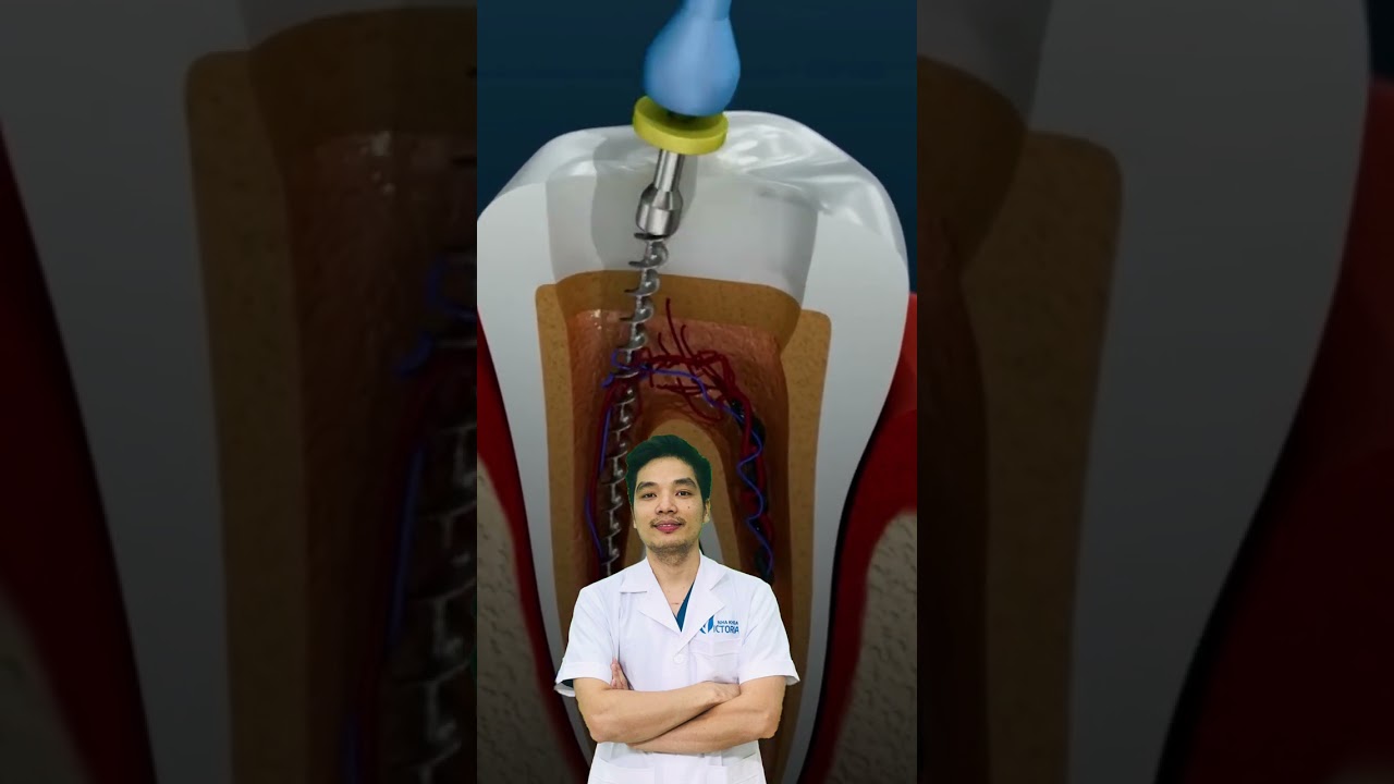 Điều Trị Tủy Răng Không Đau | Nha Khoa Victoria