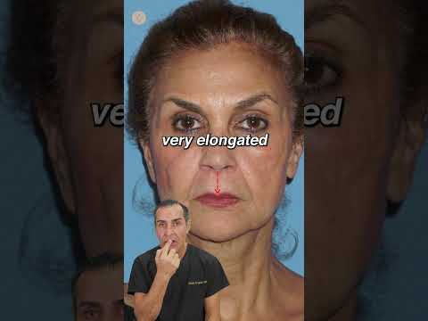 Facial Rejuvenation Case Study #plasticsurgeon #beforeandafter #transformation #antiaging #cosmetic