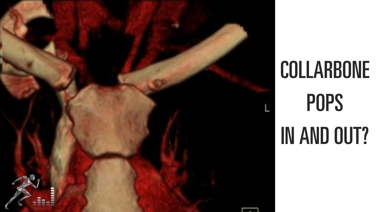 Is a Popping Collarbone Worrying? 🩺