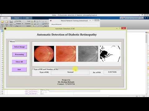 Diabetic Retinopathy Detection in Fundus Images Using Matlab Code