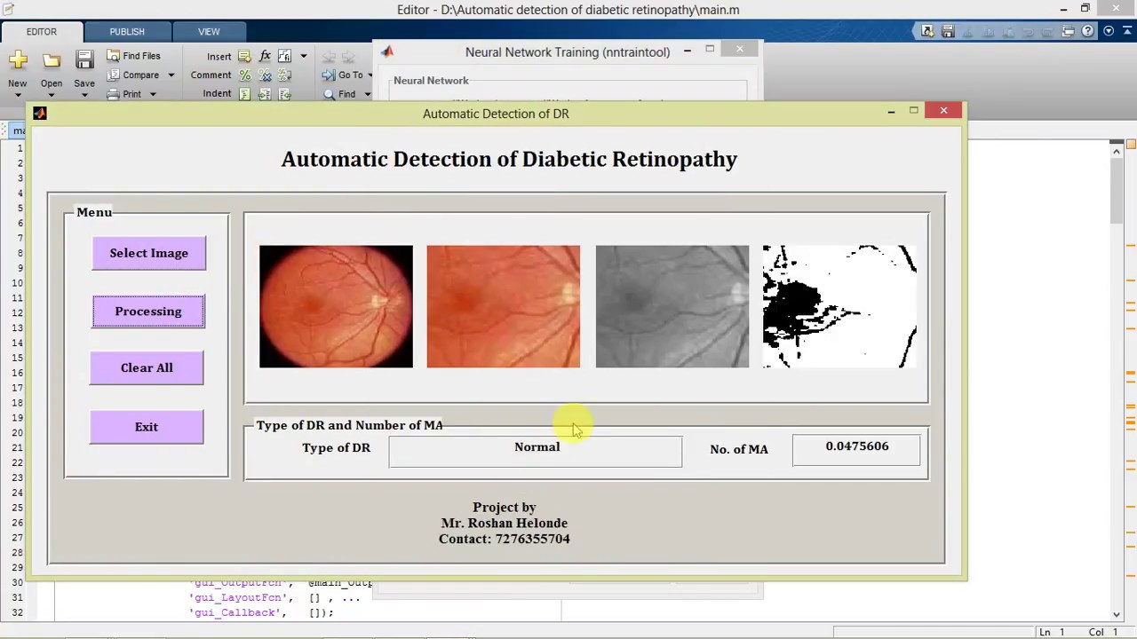 Diabetic Retinopathy Detection in Fundus Images Using MATLAB