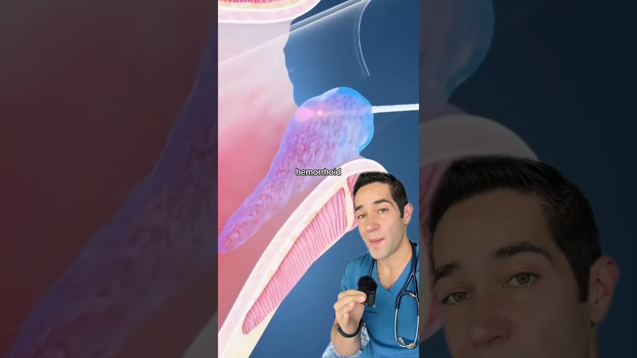 Effective Hemorrhoid Removal: How Laser Surgery Works 🔥