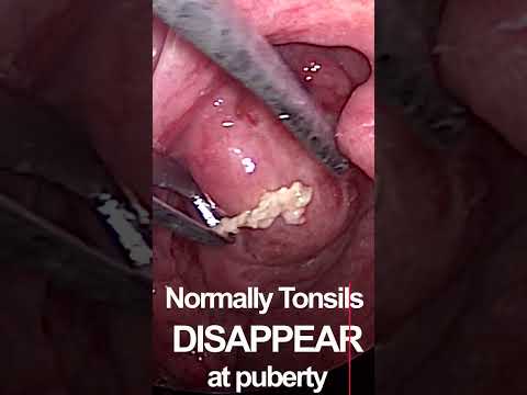 Squeezing infected tonsils
