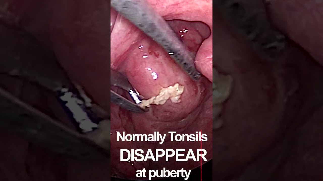Understanding Infected Tonsils: Causes, Symptoms, and Treatment Options 🩺