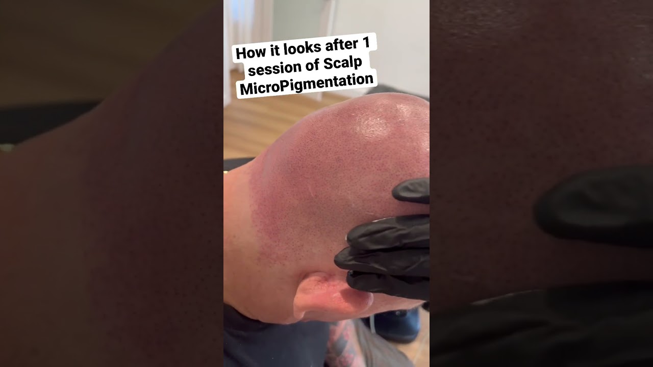 SMP Transforms Life for Client with Alopecia 🌟