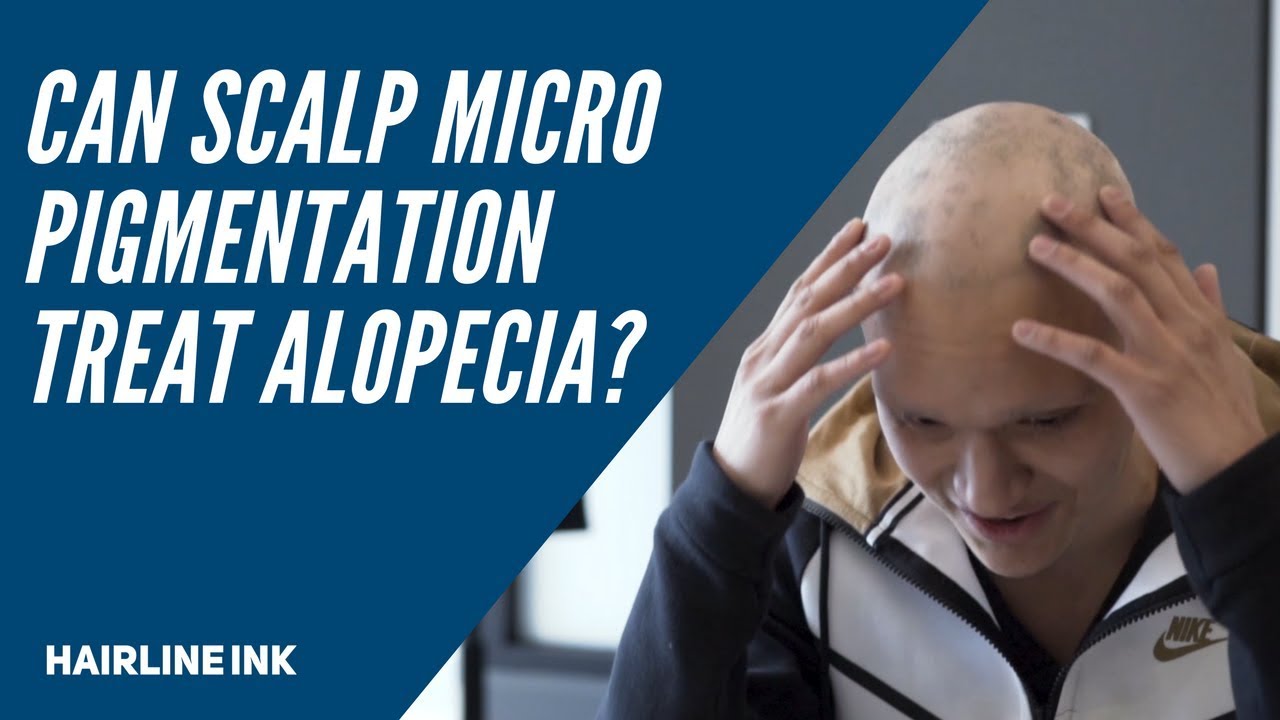 Can Scalp Micropigmentation Help Alopecia? 🤔