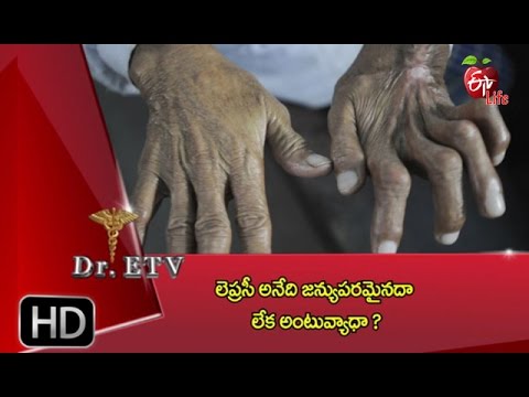 Can Leprosy Be Hereditary or Transmitted? 🧬